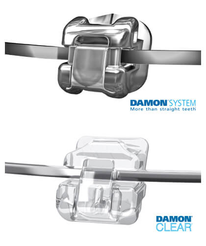 Damon System orthodontics stainless-steel bracket (upper) and clear bracket (lower)