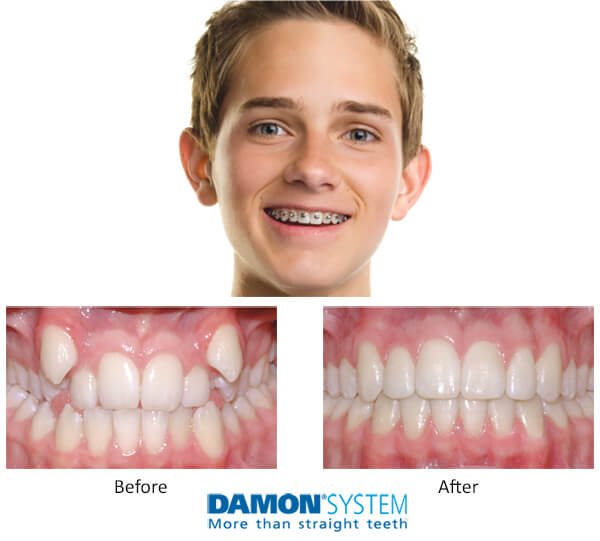 Closeup face of a teenage boy wearing braces above before and after pictures of Damon System braces