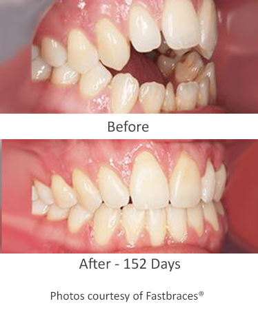 Before and after Fastbraces open bite photos