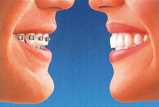 A picture of an adult smile on the left with traditional braces, and an adult smile on the right, showing Invisalign