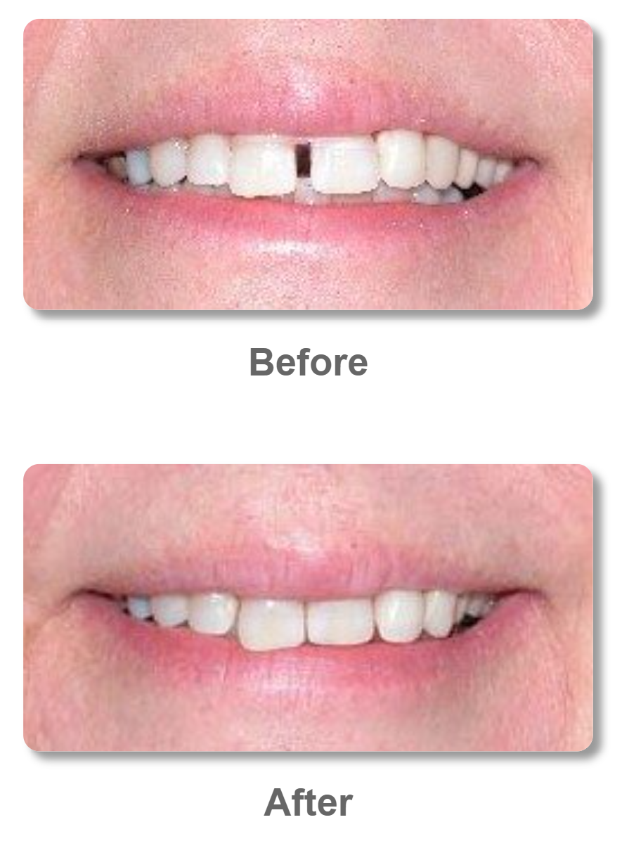 An image showing the before and after results of the Feeth Effects dental bands
