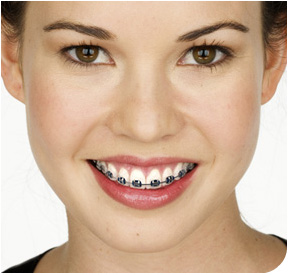 Young woman with braces