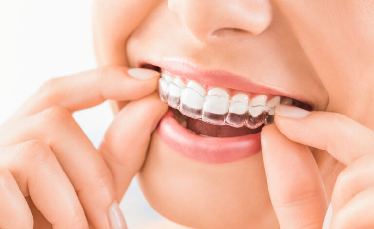 Clear Aligner Attachments in Bee Cave: What Are They and Why Are They Needed?