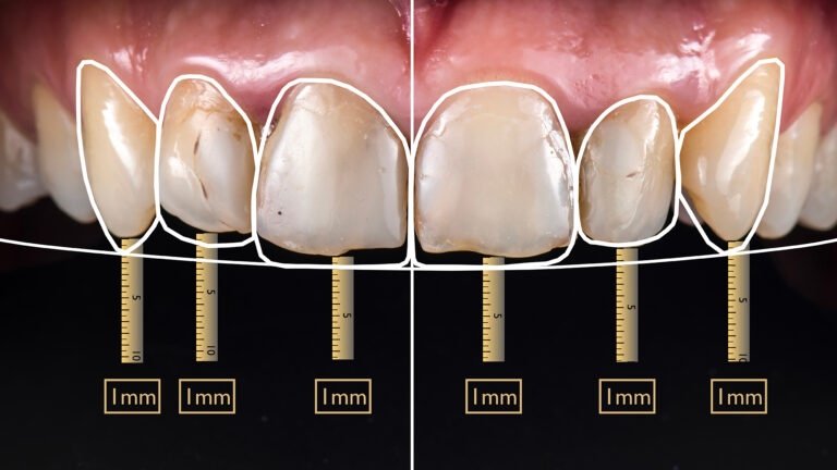 Dental image illustrating the width of front teeth